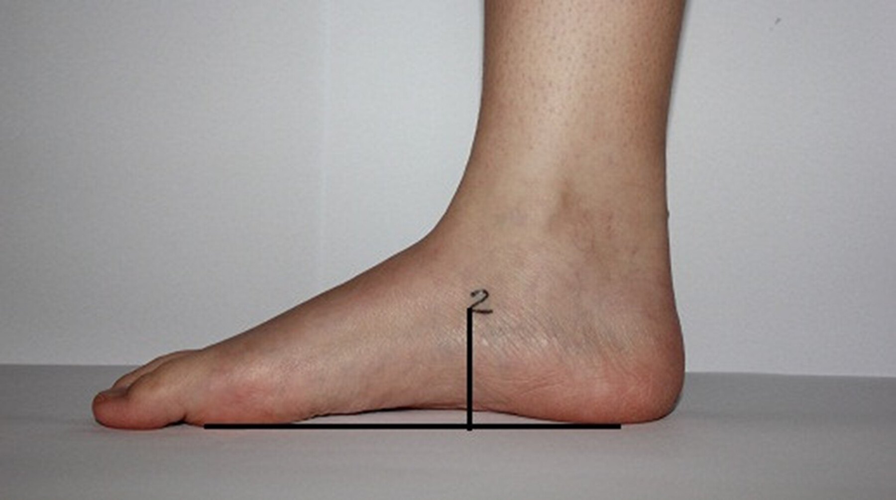 ฝังเข็มเพิ่มความสูงแล้วจำเป็นต้องทานยาเพิ่มความสูงด้วยไหม 